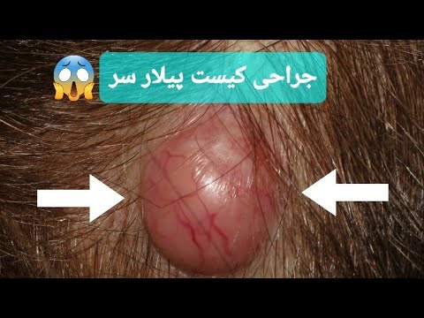 تصویری: 3 راه برای آوردن کیست به سر