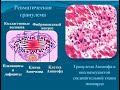 Патологическая анатомия-2 Лекция 2: Ревматические болезни.