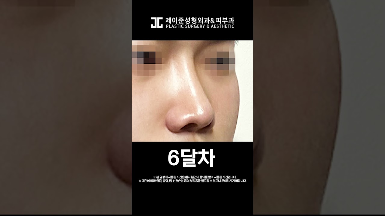 [Jayjun Phẫu thuật thẩm mỹ & Da liễu] 👃Giải quyết nỗi lo mũi tẹt + mũi ngắn! 👃 So sánh trước và sau khi phẫu thuật nâng mũi #shorts