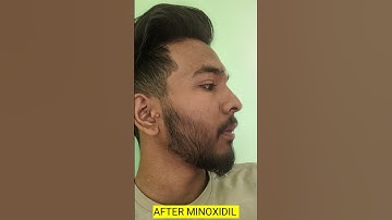 minoxidil beard transformation || minoxidil beard growth journey #minoxidil #beard #beardgrowth