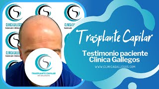 TRASPLANTE CAPILAR FUE ZAFIRO 👩🏻‍🦲👉🏼🧑🏻 TESTIMONIO PACIENTE CLINICA GALLEGOS 🏅