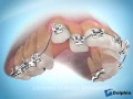 Alignement orthodontique 2 canines