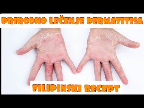 Video: Dermatitis - Zdravljenje Dermatitisa Z Ljudskimi Zdravili In Metodami Doma