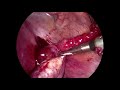Ectopic Pregnancy : Laparoscopic traitement