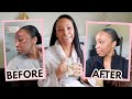 Microneedling Update! | What REALLY Happened to My Skin & How I Transformed it in 3 Weeks!