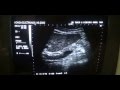 how to locate COMMON BILE DUCT by ultrasound