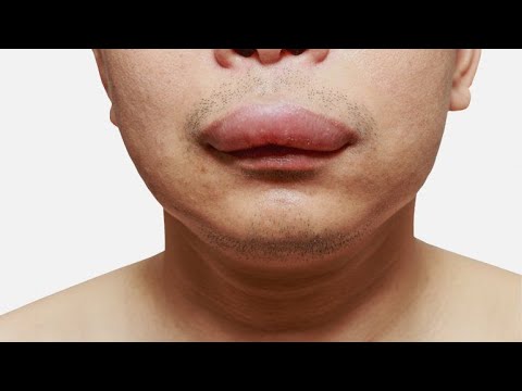 Video: Cómo curar los labios hinchados: 15 pasos (con imágenes)