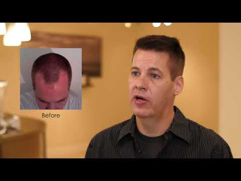 How long does a hair transplant result last? Our patient shows off his results 10 years latter.
