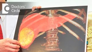 What is TACE for Liver Cancer? - Dr. Ravichand Siddachari