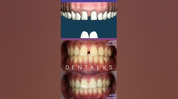 #veneers Worried about Gap between Front Tooth ?? Dental Veneers | Patient Education Animation