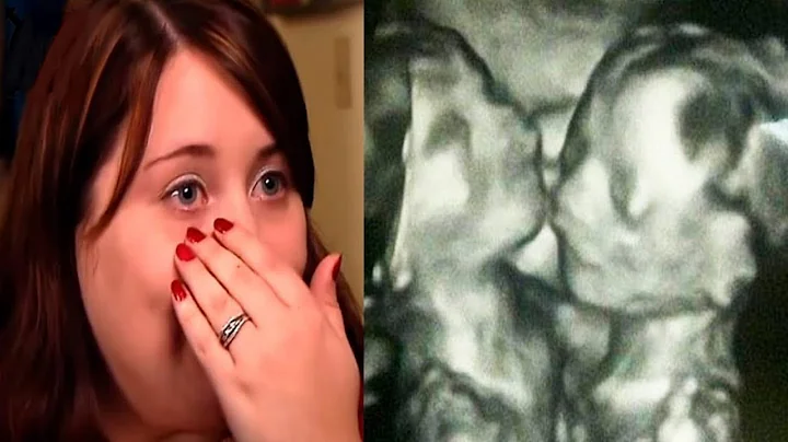 The doctor said stop the pregnancy they are siames...