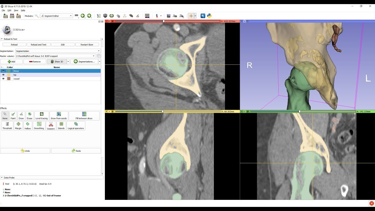 Femur Segmentation Using Masked Region Growing In 3d Slicer Youtube