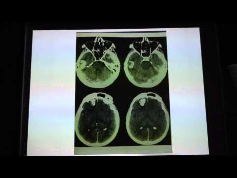 Vídeo: As contusões cerebrais são sérias?
