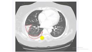 USMLE World step 2 ck - Pulmonary - part 1 شرح أسئلة