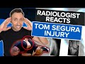 Tom Segura Injury Explained - Radiologist Reviews Imaging