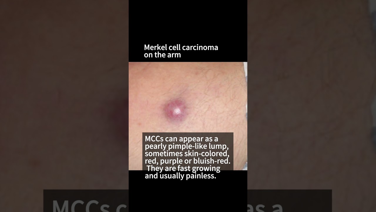 What does Skin Cancer look like? Merkel Cell Carcinoma 
