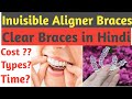 Invisible Aligner Braces |Clear Braces Treatment Hindi | Invisalign Cost, Time & Procedure