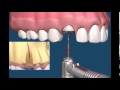 Хирургическая стоматология  Как удалять зубы  Примеры удаления зубов  Сложное удаление