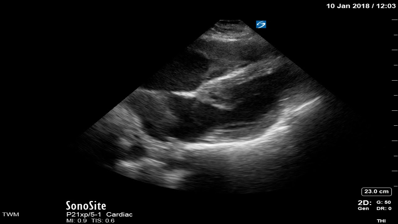 Ventricular Standstill POCUS YouTube