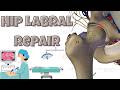Hip Labral Tear Surgery Explained (Surgery + Rehab)