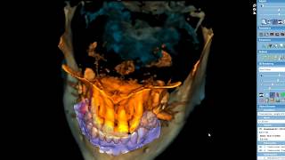 Fully Guided Implant with FDA Approved Planmeca Romexis