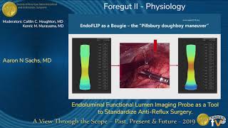 Endoluminal Functional Lumen Imaging Probe as a Tool to Standardize Anti-Reflux Surgery screenshot 2