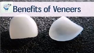 Benefits Of Dental Veneers