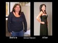 Weight Loss Surgery - The N.E.W. Program