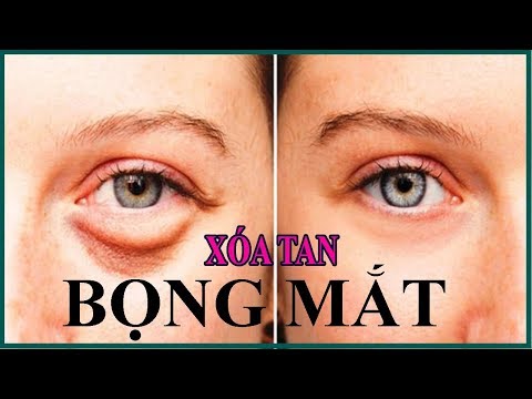 Video: Cách xóa vết thâm dưới mắt trong 5 phút