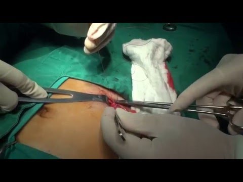 APPENDECTOMY (Open technique)