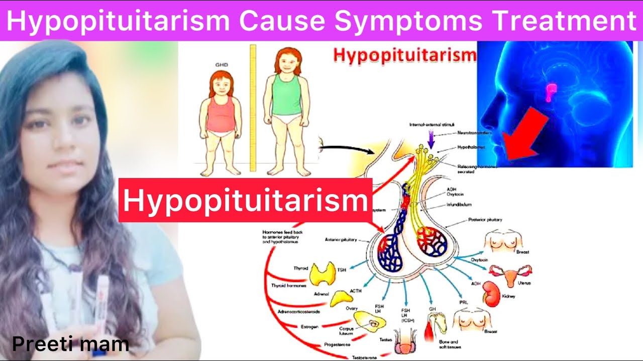Hypopituitarism Cause Symptoms Diagnose Treatment | What is ...