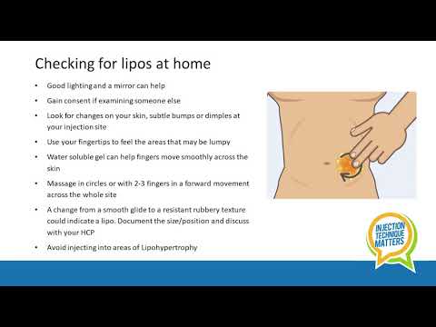 Debbie Hicks | Lipohypertrophy | Injection Technique Matters