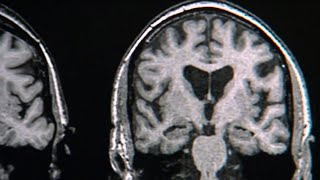 How to use your brain to combat chronic pain