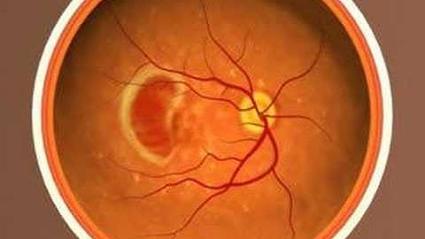 Video Illustration of Age-related Macular Degeneration (AMD)