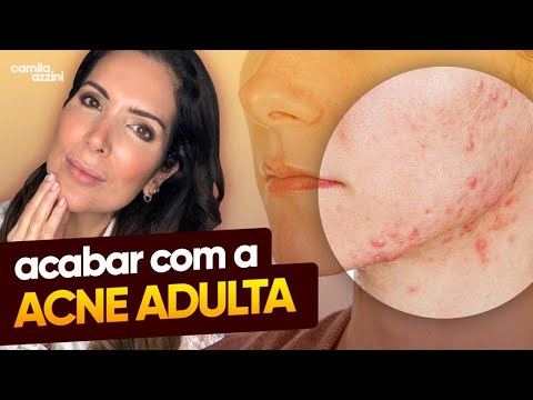 Vídeo: Como reduzir a acne da menopausa (com fotos)