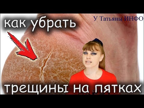 ПЯТКИ КАК У МЛАДЕНЦА! Простой рецепт убрать трещины на пятках.