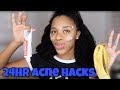 Getting Rid of My Acne in 24 hours Using Weird Hacks (ft. Curls Curls)