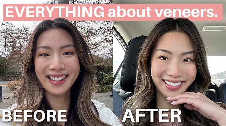 Everything to know about veneers | cost, pain, recovery