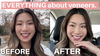 Everything to know about veneers | cost, pain, recovery