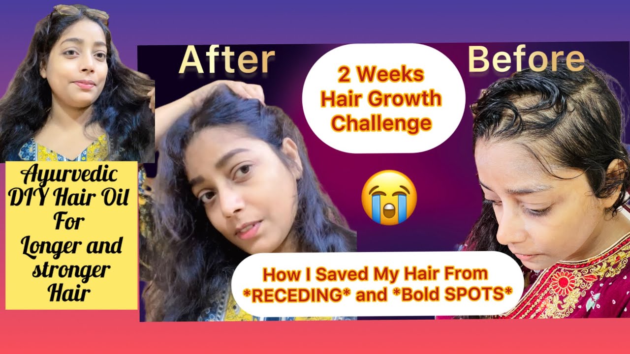 2 Weeks Hair Growth Challenge💯💁‍♀️How I Saved My Hair From *RECEDING