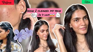 How I Cleared My Acne In Just 7 Days Skincare Routine For Clear Skin