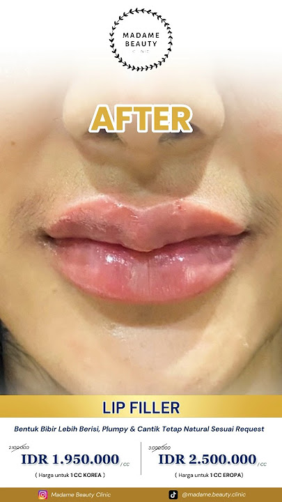 Madame Bestie : Mau BIBIR SEKSII??? Filler Bibir solusinyaa Gaes !!