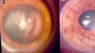 Can Extreme Keratoconus Be Corrected? Yes Gulani T- Intacs Technique With Corneoplastique