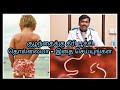      worms problem in children  tamil  dr sudhakar 