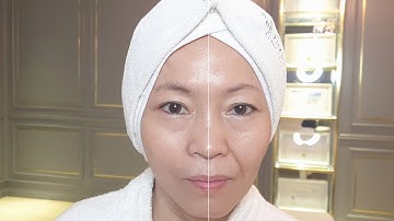 CĂNG DA, XÓA RÃNH CƯỜI NGAY TỨC THÌ, SAU 30 PHÚT THẤY NGAY SỰ KHÁC BIỆT GIỮA 2 NỬA BÊN MẶT