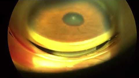 Gonio video photographed on iPhone