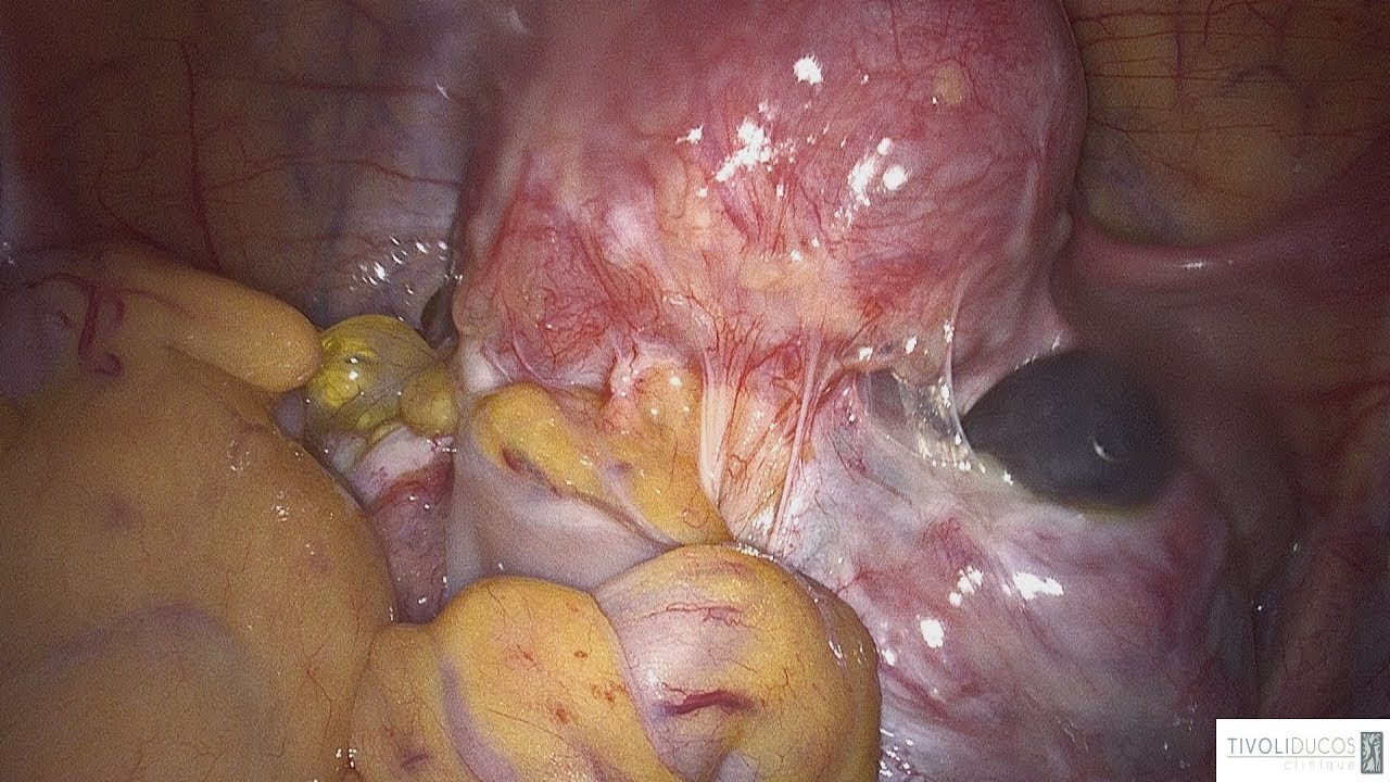 Surgical management of rectovaginal endometriosis
