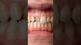 Overlapping Teeth Correction 😱 No Braces Treatment | Straight Smile Result