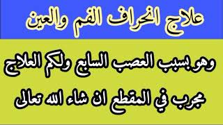 علاج انحراف الفم والعين وهو بسبب العصب السابع ناجح ومجرب ان شاء الله تعالى