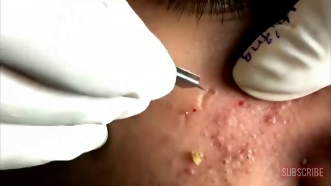LARGE Blackheads Removal Best Pimple Popping Videos Ever YouTube